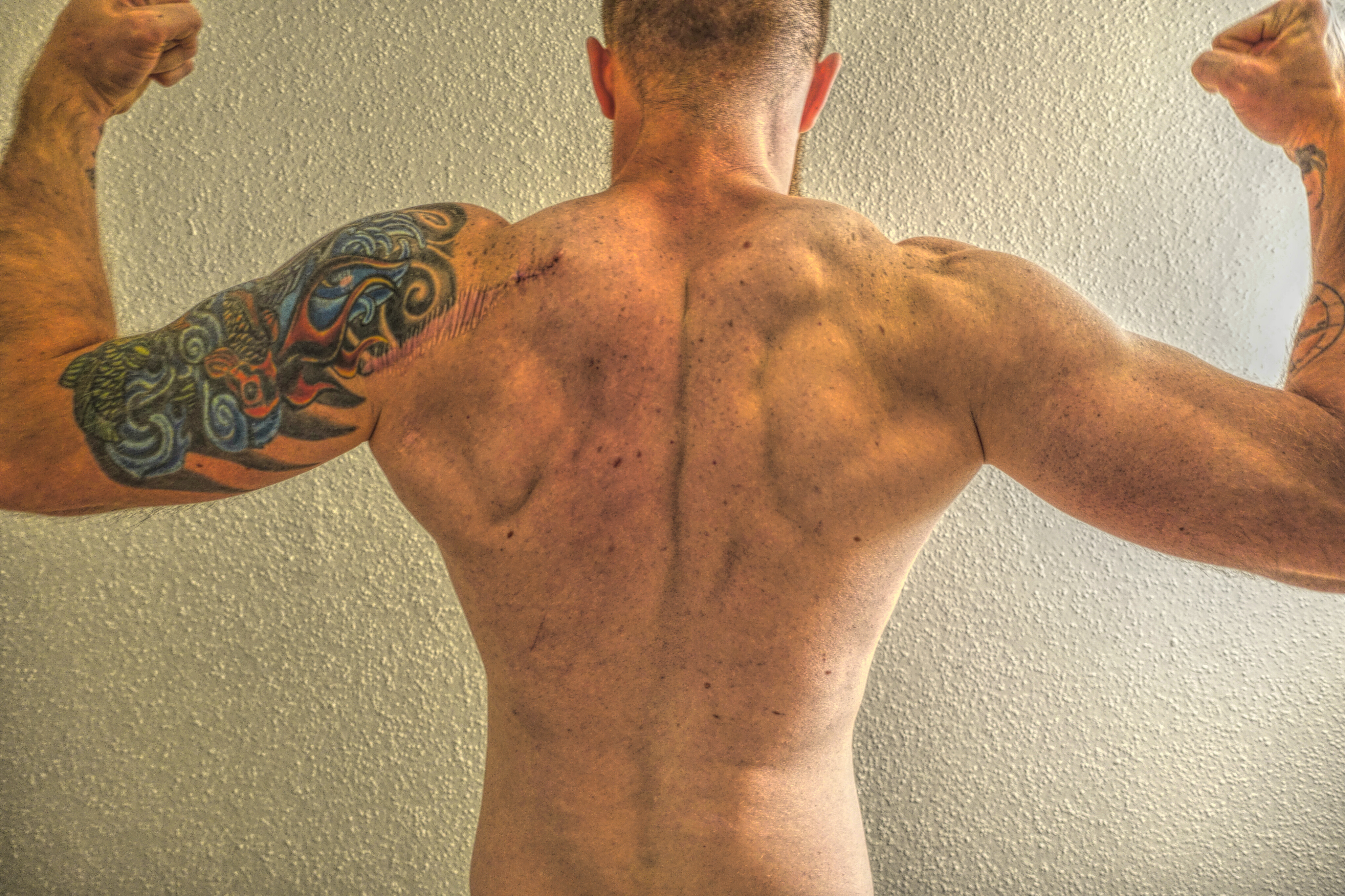 Surgery Scar Top Left of Shoulder